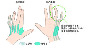 杉並区、永福町、西永福、久我山、明大前、世田谷、肘、肘部管症候群、手のしびれ
