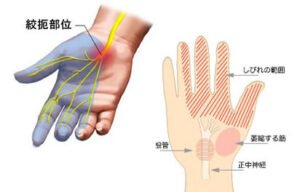 杉並区、永福町、西永福、久我山、明大前、世田谷、手首、手根管症候群、手のしびれ