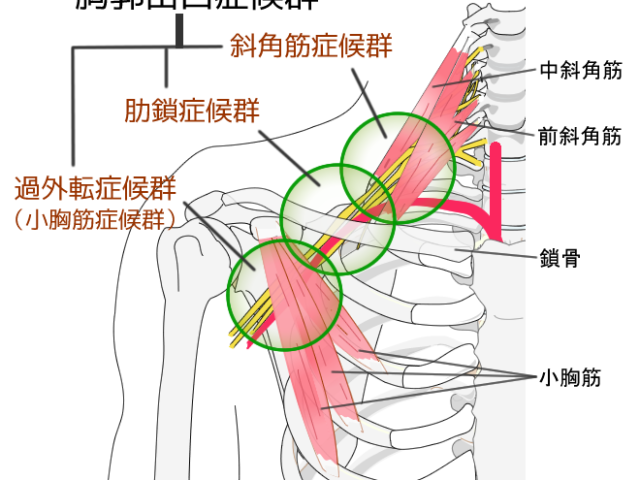 胸郭出口症候群の初期症状を見逃さないためのサインと対処法